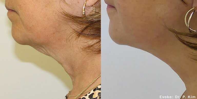 Before & After Face Aesthetics in Collierville, TN