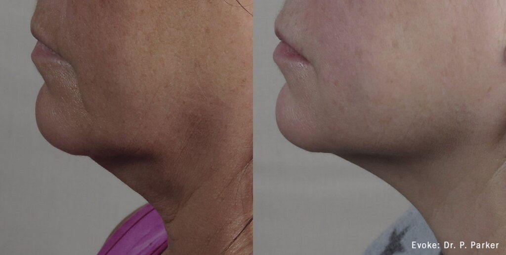 Before & After Face Aesthetics in Collierville, TN